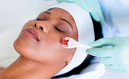 Harmonização Facial - microagulhamento Dra Gislaine Santos